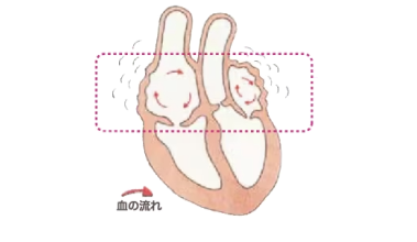 心房細動の患者さんへ