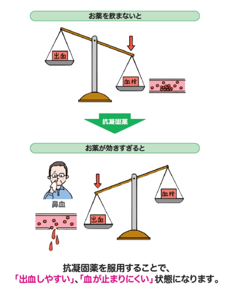 末梢動脈疾患（PAD）の患者さんへ｜成人の方へ｜イグザレルトを